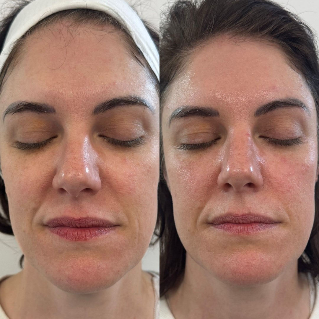 BBL Skincare Journey: The first steps at NG Clinic with Natalie Godefroy