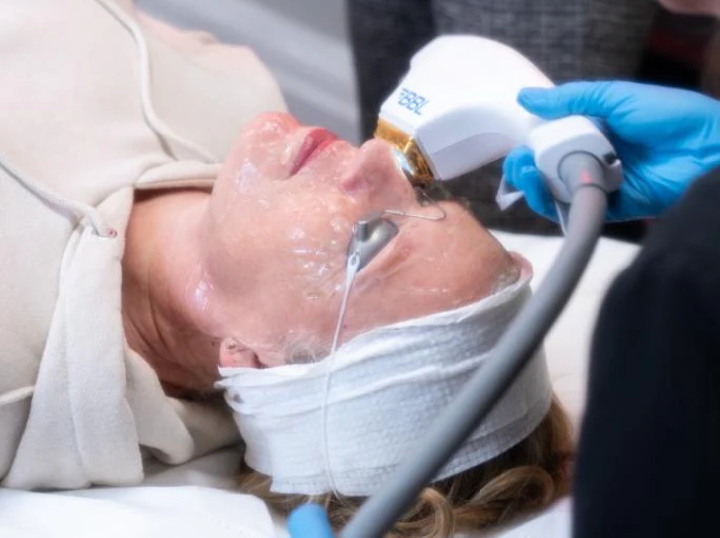 BBL treatment: Next-level skin care and facial treatments in Leicester